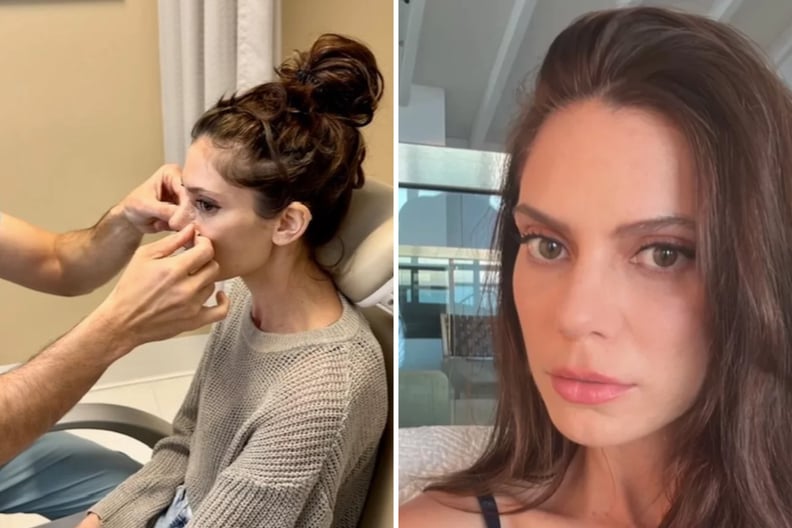 Baby Rhinoplasty before and after