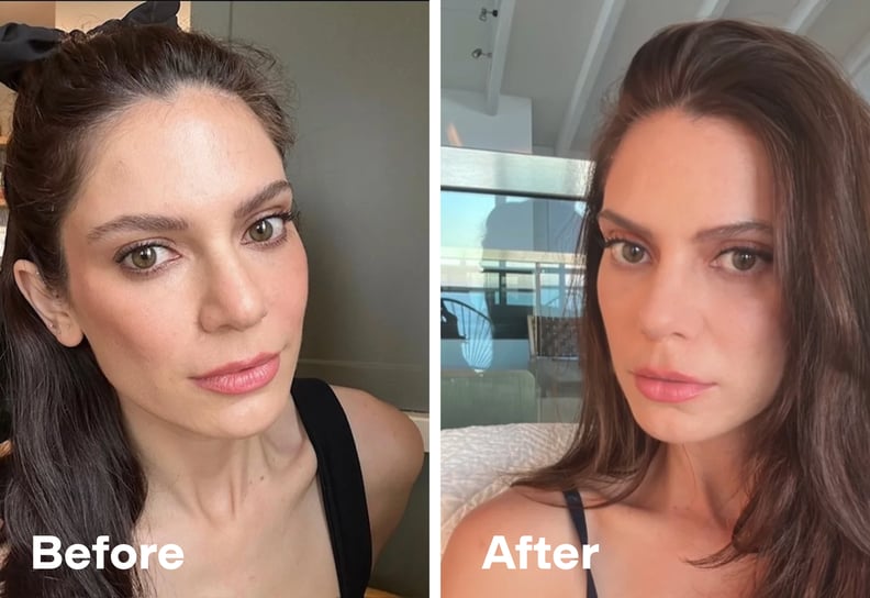 Before and After Baby Rhino Surgery