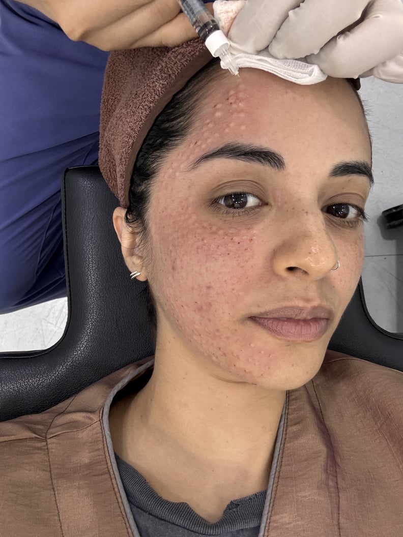 salmon sperm injections review