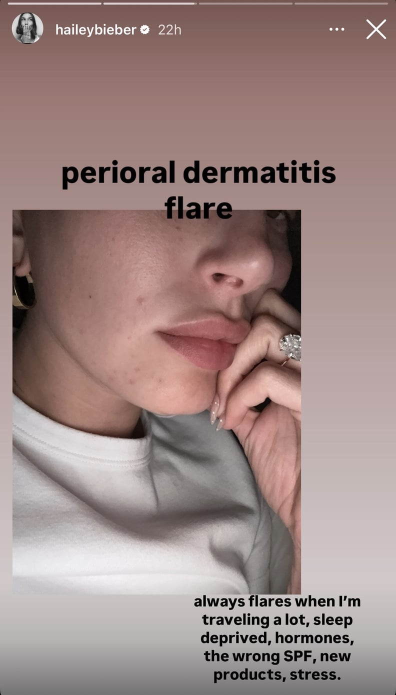 Hailey Bieber Dermatitis