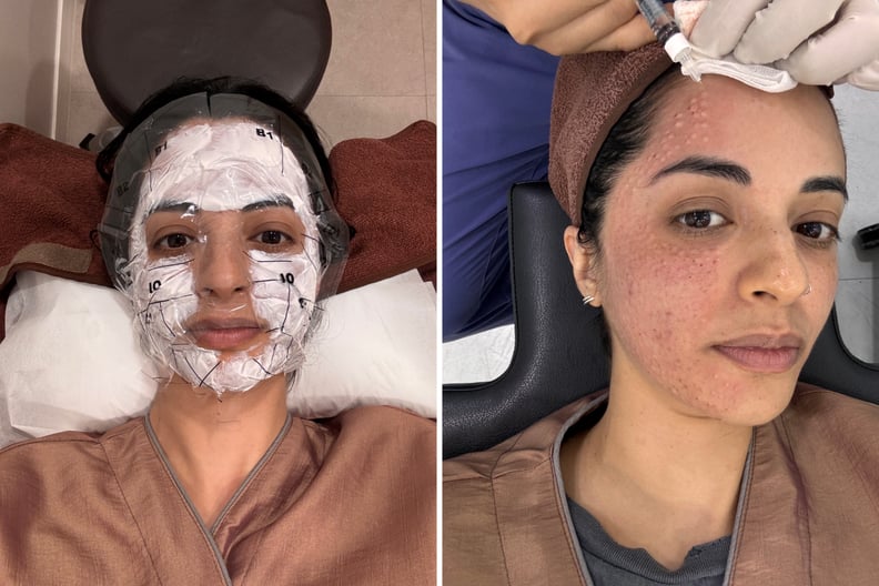 salmon sperm injections review