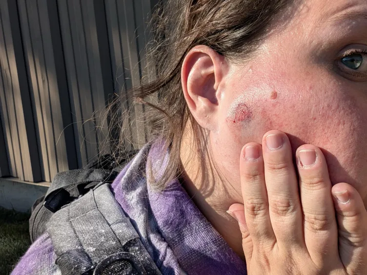 A woman holds her face with her hand. On her cheek there is a wound around the size of a nickel. The skin is raw and there is bruising around the wound. There is white residue on her shirt and backpack.