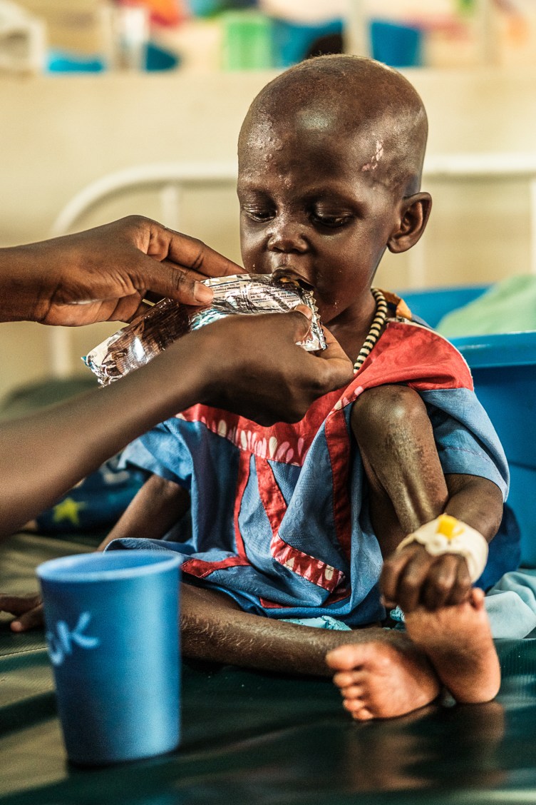 A too-thin child sits on a hospital bed, eating a nutritional supplement being held to his lips.