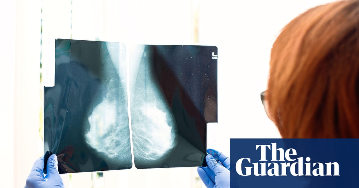 Une simple analyse de sang peut prédire quel traitement contre le cancer du sein fonctionnera le mieux, selon une étude