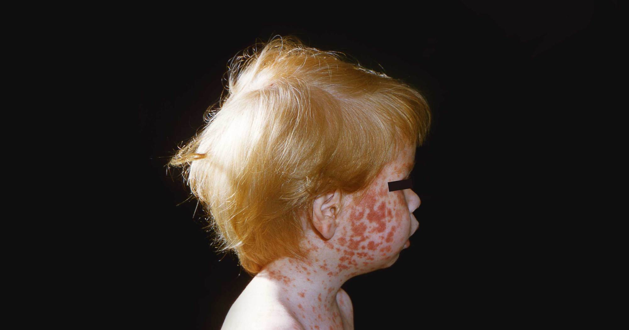 How RFK Jr.’s Vaccine Agenda Risks a Return of Childhood Plagues — ProPublica