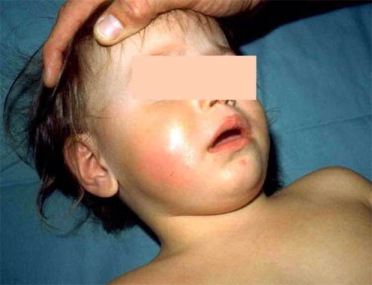 A toddler with their eyes redacted, covered in sweat with flushed cheeks, wet hair and a hand on his head.