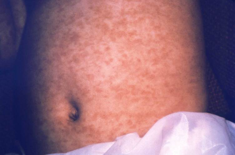 A child’s stomach is uniformly covered in small, tightly packed reddish brown patches. 