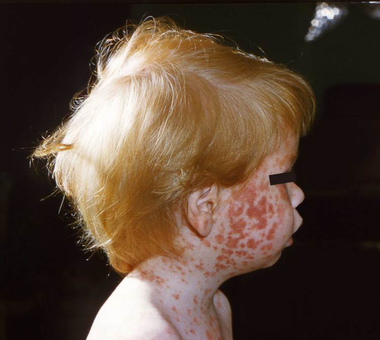 Large, red, raised patches cover a child’s cheek in such quantity that many of the patches connect to one another and only small strips of normal skin show through between. The red patches continue in a less dense pattern down the child’s neck and onto his chest. 