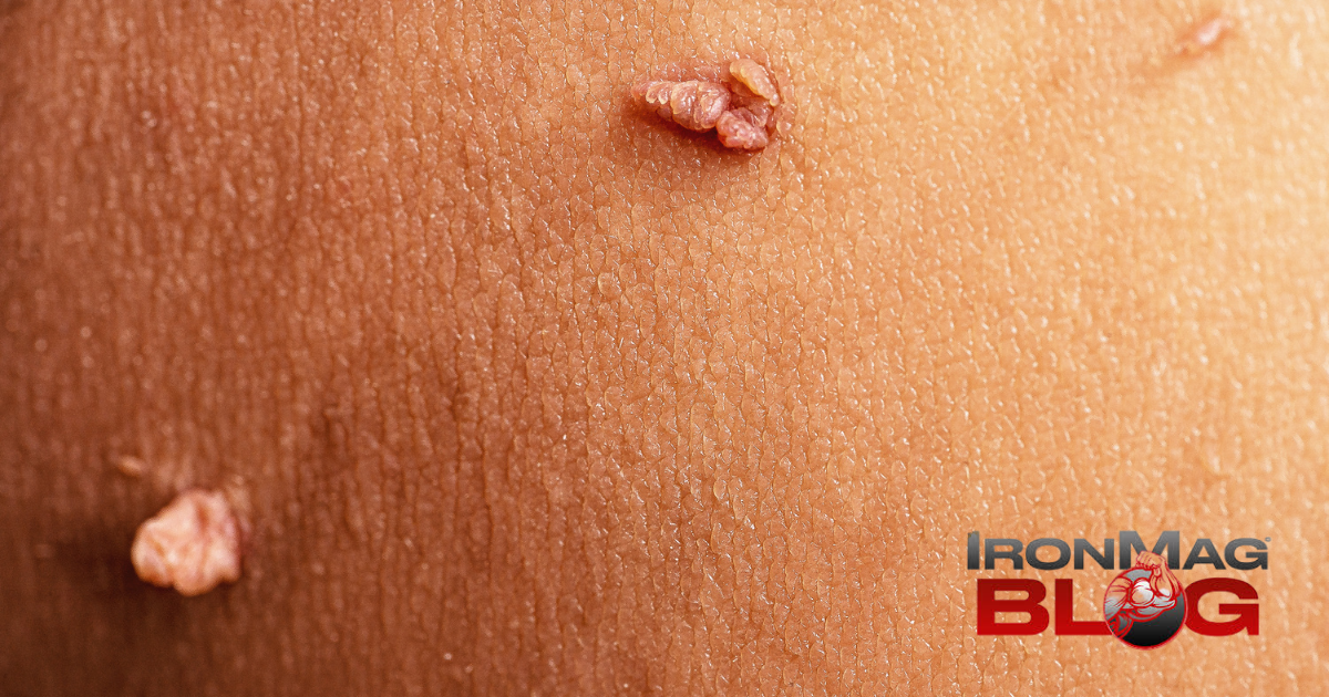 Les acrochordons sont-ils le signe d’un taux élevé d’insuline ? – Blog de musculation et de fitness IronMag