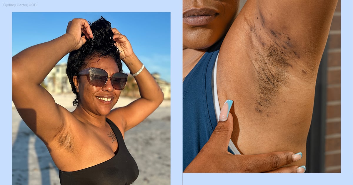 How I Learned to Accept My Hidradenitis Suppurativa