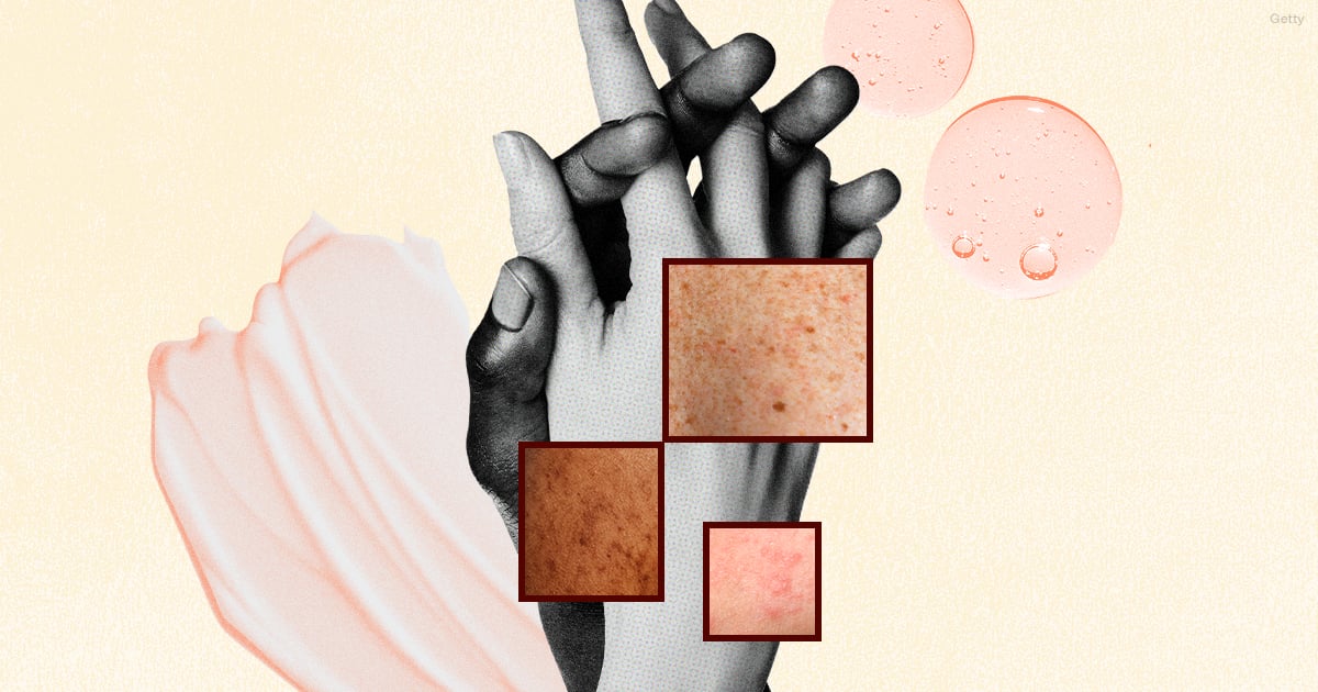 Couples Share How Skin Conditions Impact Their Relationship