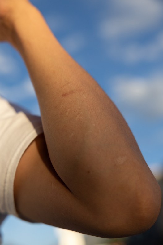 A close-up view of a person’s bent arm, showing healed scars on the forearm against a bright blue sky with scattered white clouds.